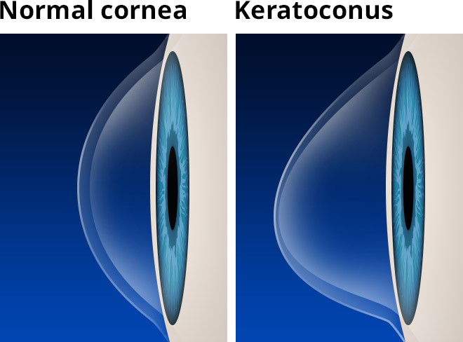 keratoconus corneal transplant